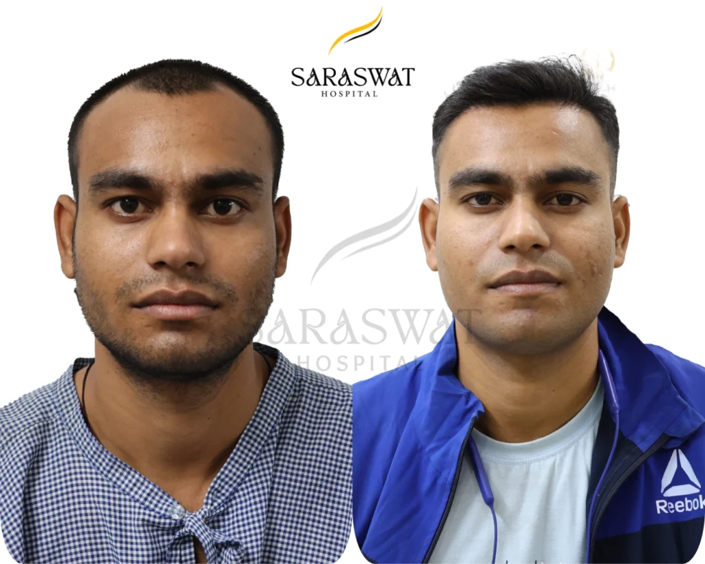 Hair Transplant Results