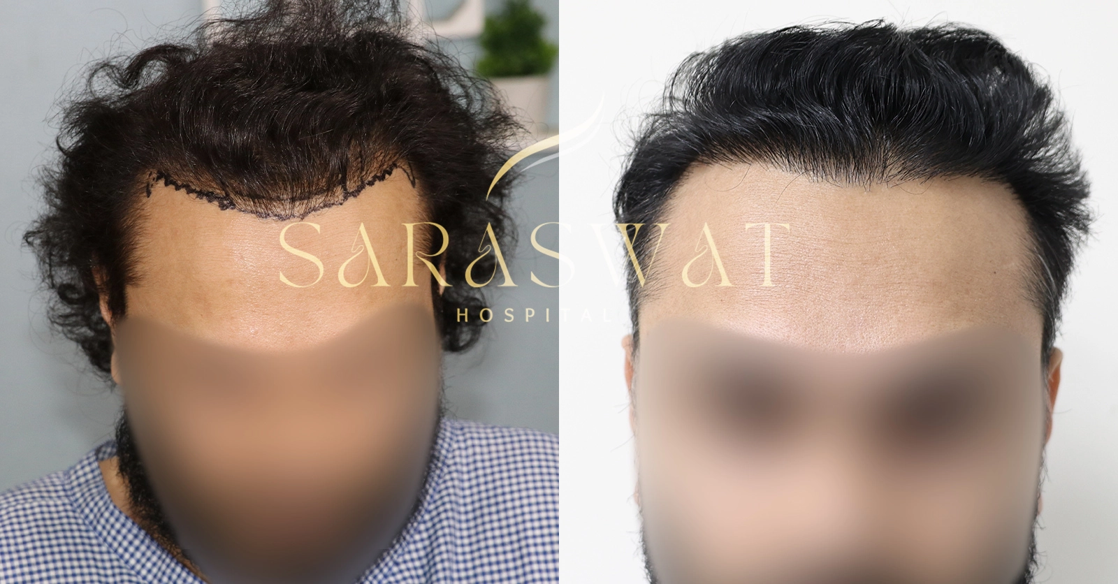 Repair Hair Transplant Result