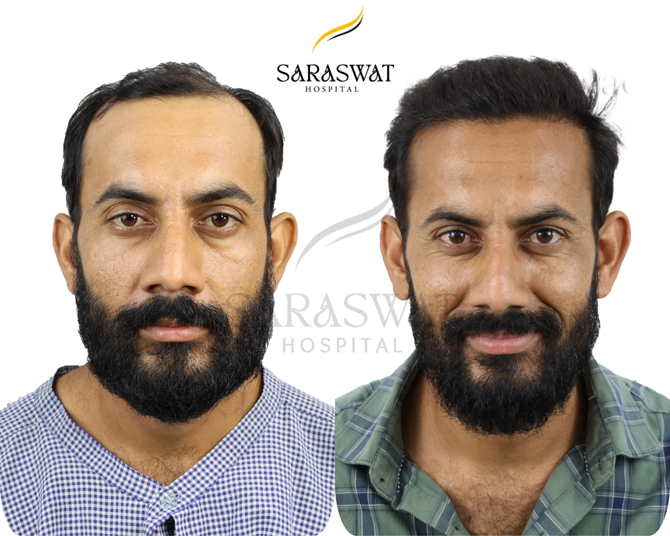 Hair Transplant Before and After