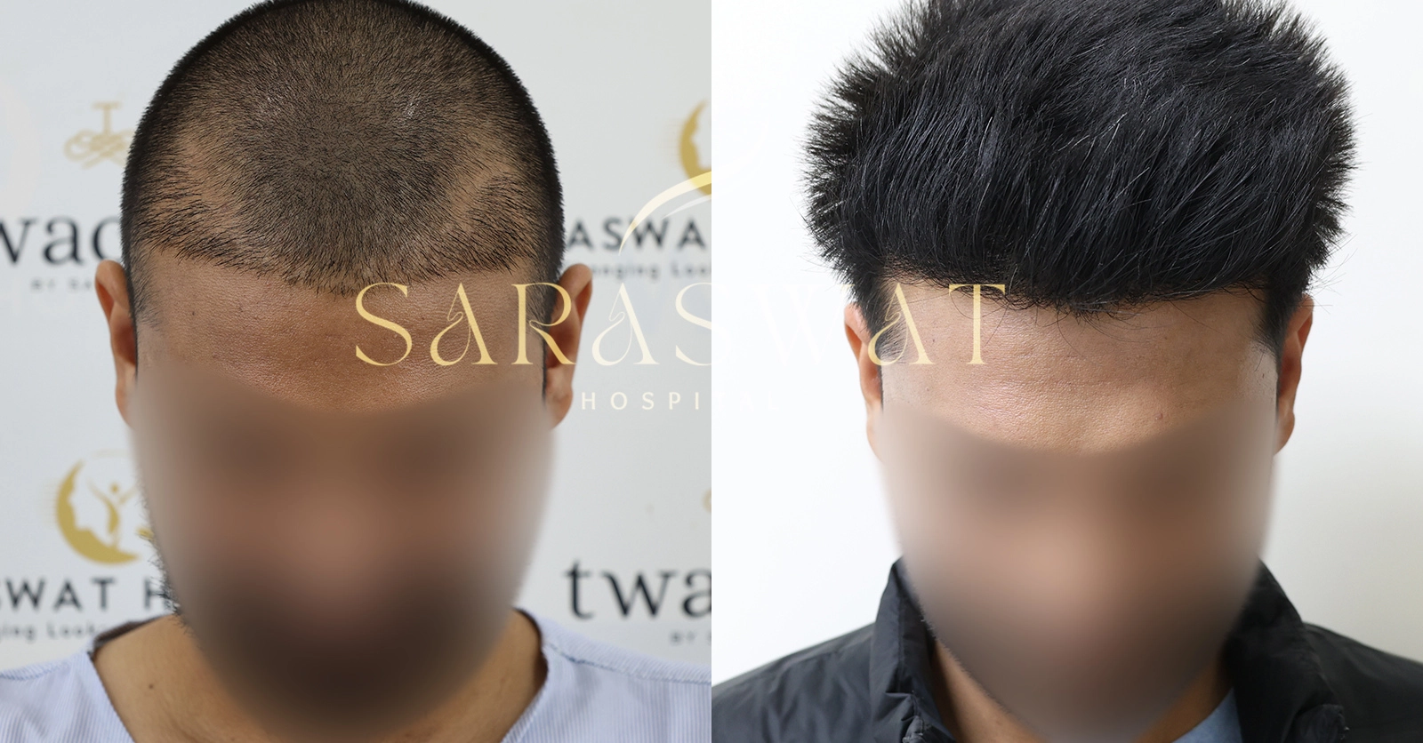 Repair Hair Transplant Result