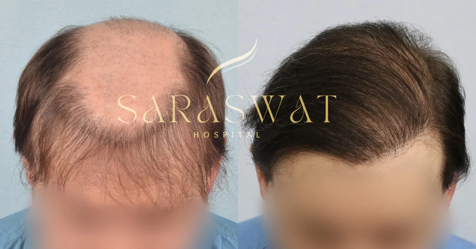 Body hair transplant result