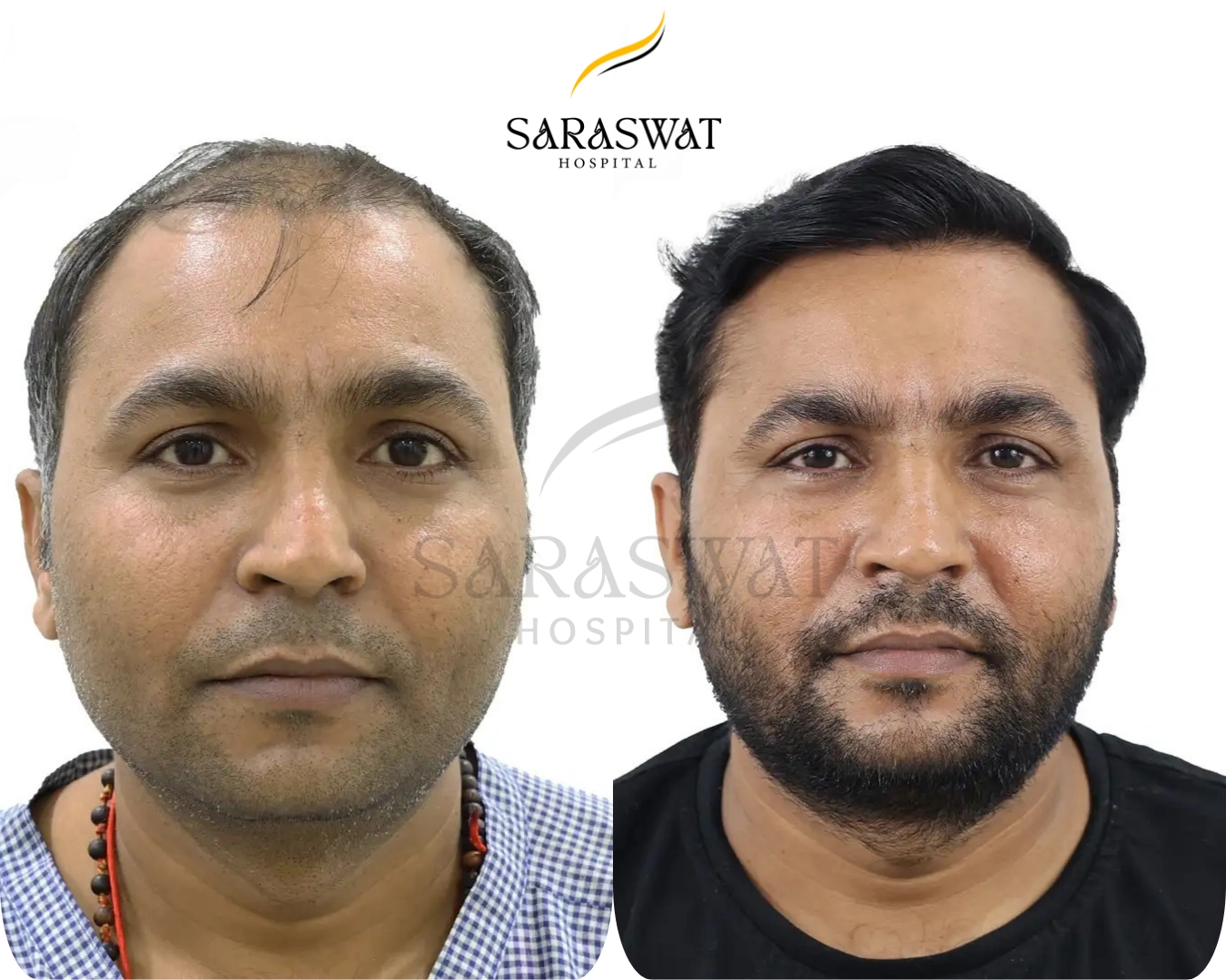 Advantages of FUE Hair Transplant in India