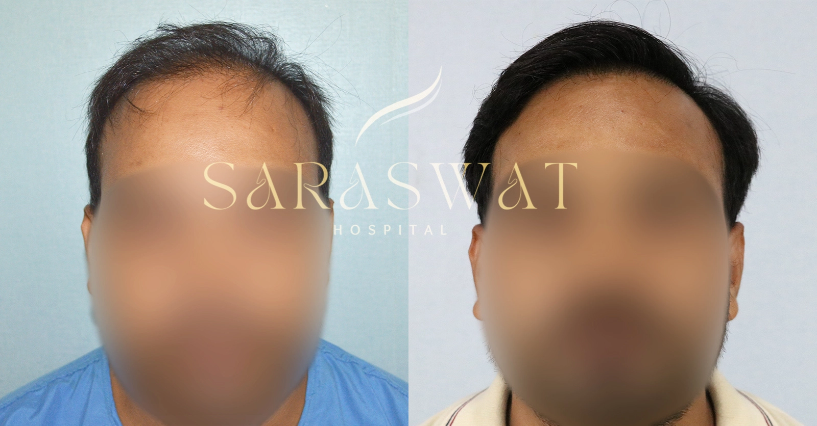 Hair Transplant Repair Result