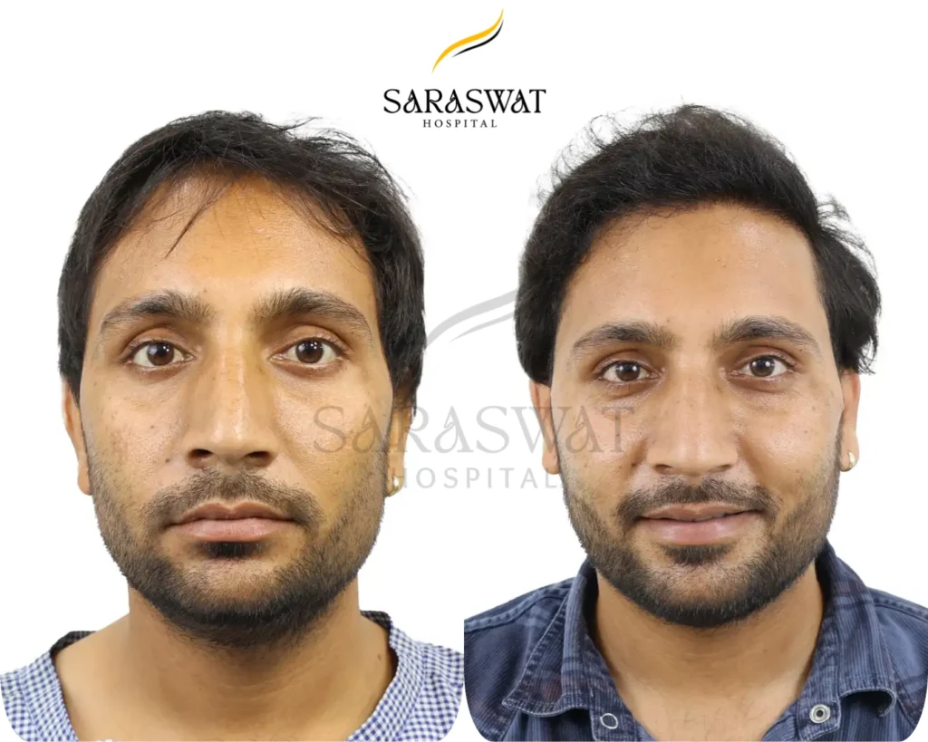 Hair Transplant Before and After Result