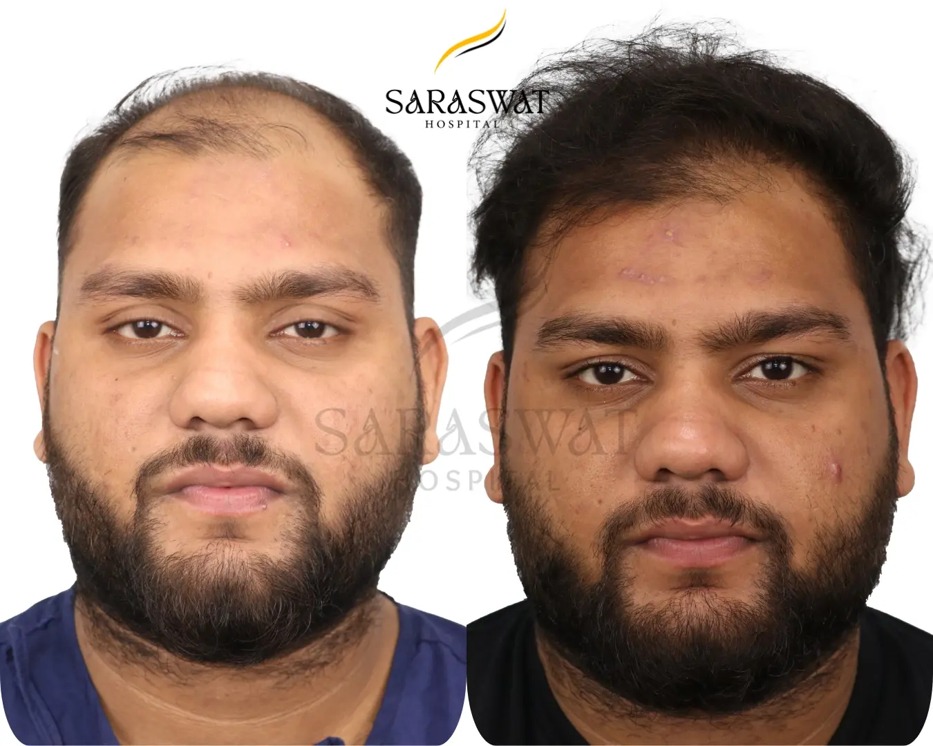 Hair Transplant Before and After Result