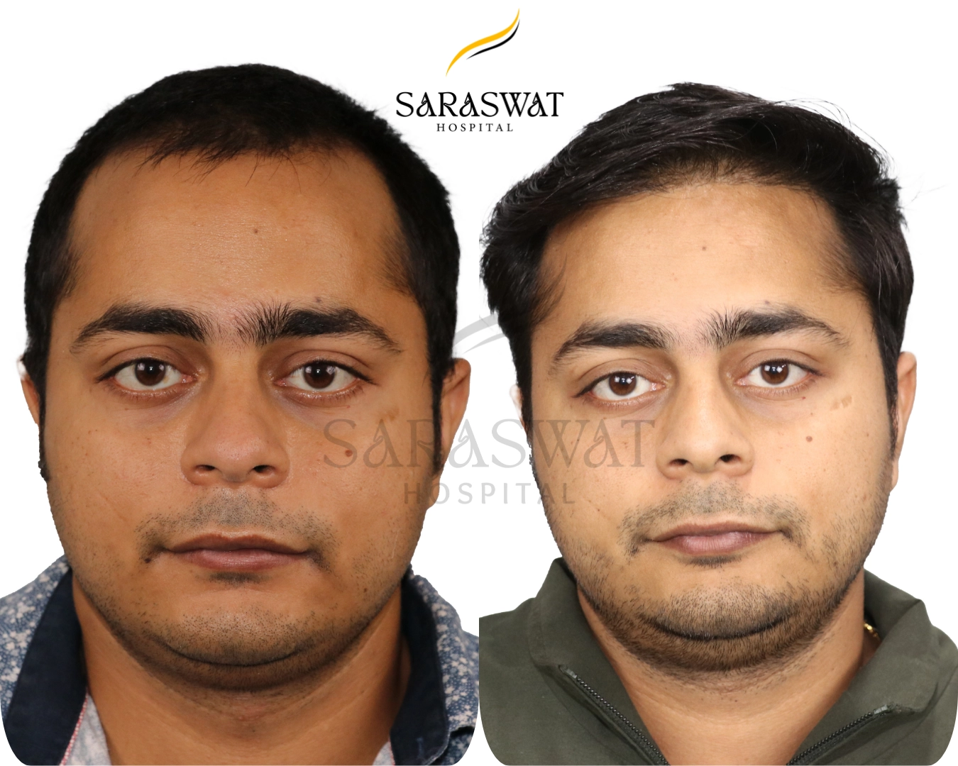 Hair Transplant Result