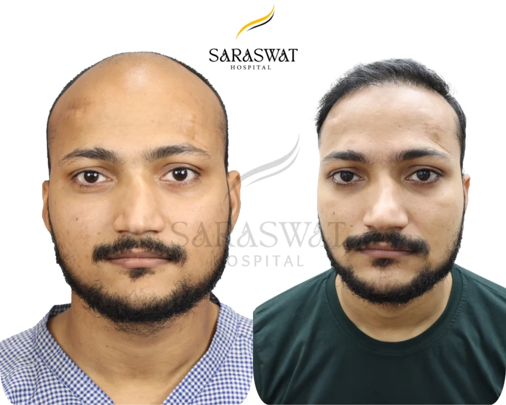 Hair Transplant Result