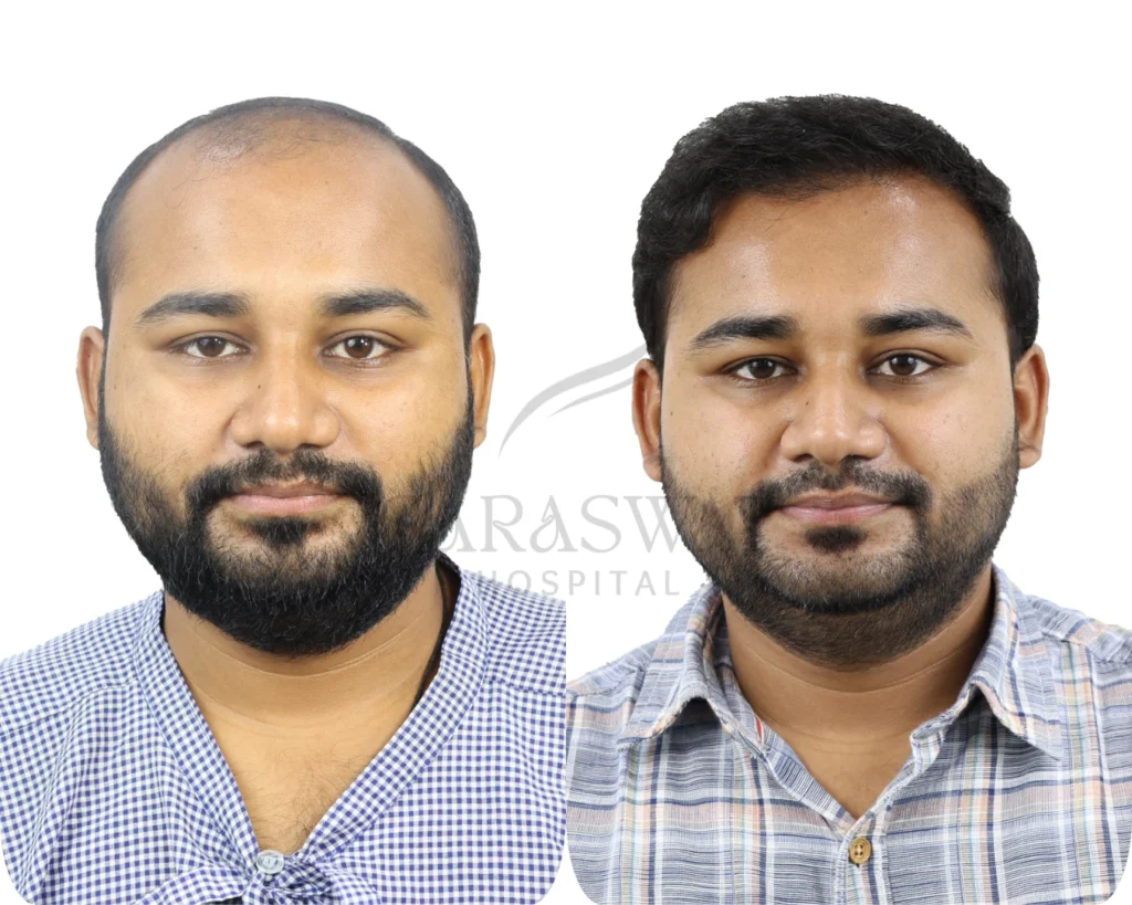 Hair transplant result