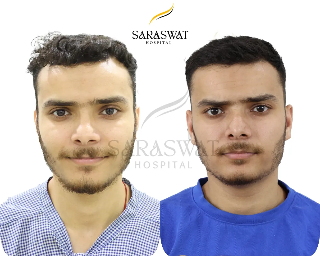 Hair Transplant Before and After