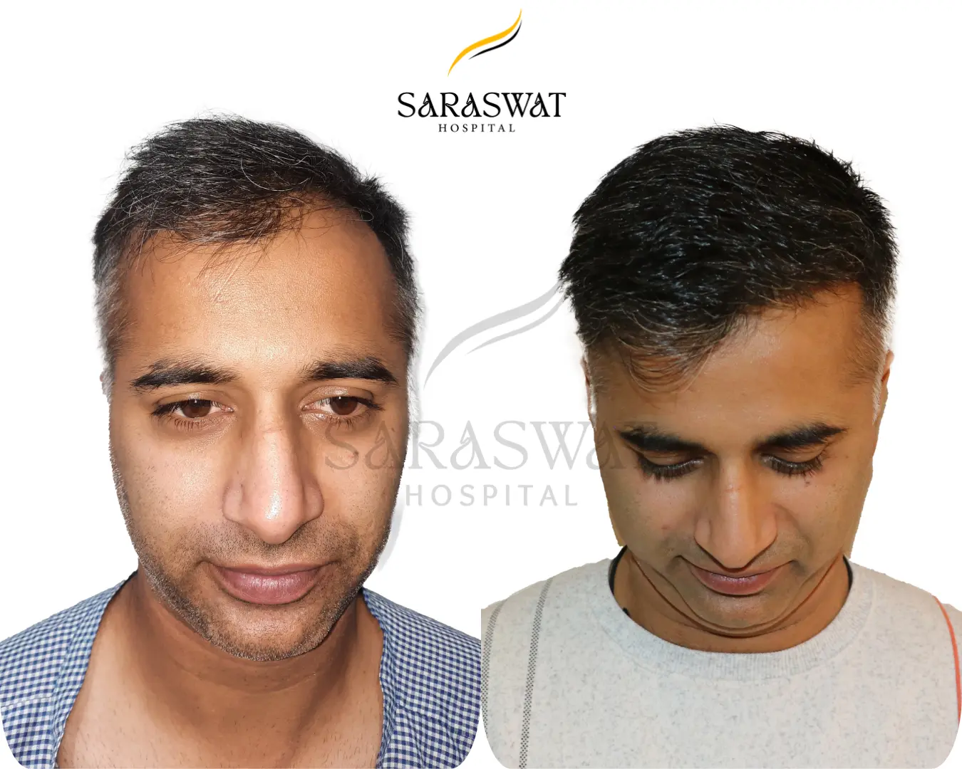 Hair Transplant Before After