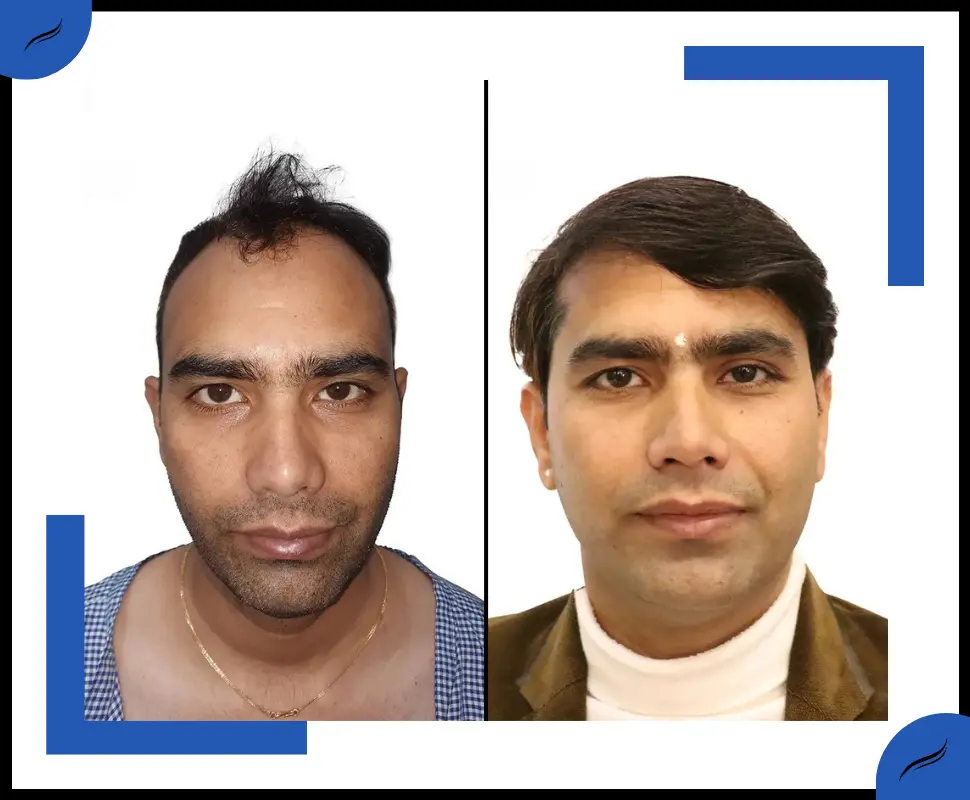 Hair Transplant Result