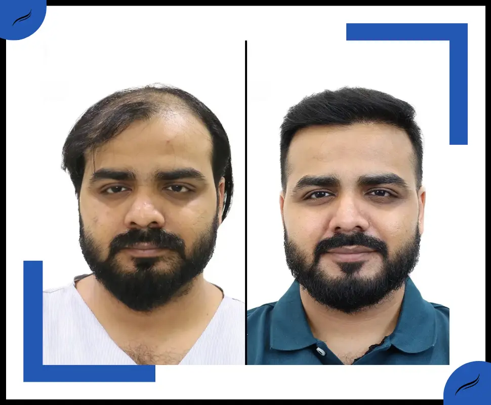 Hair Transplant Result