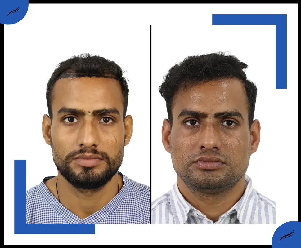 Hair Transplant Before and After