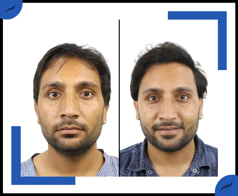 Hair Transplant Before and After