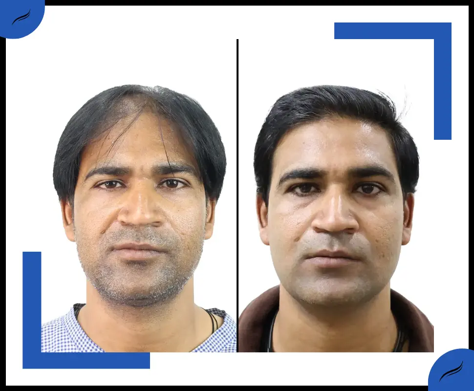 Hair Transplant Before and After | Hair Transplant Result