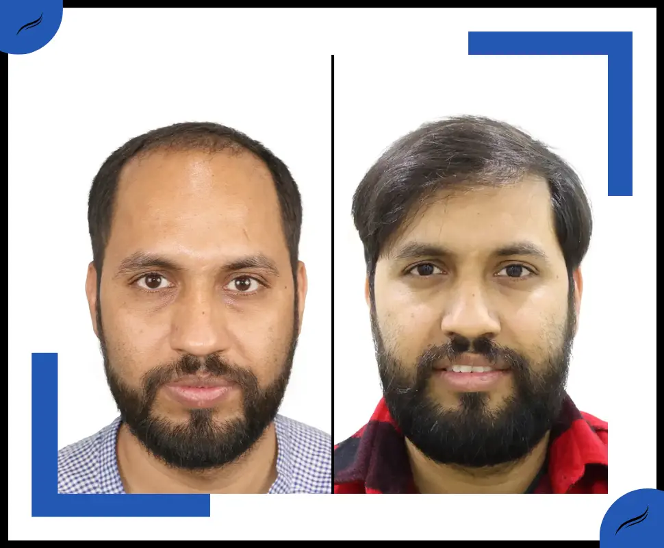 Best Hair Transplant Result in India