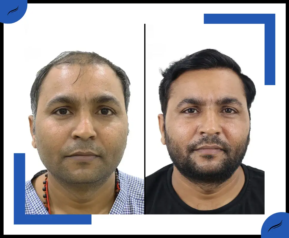 Best Hair Transplant Clinic in India