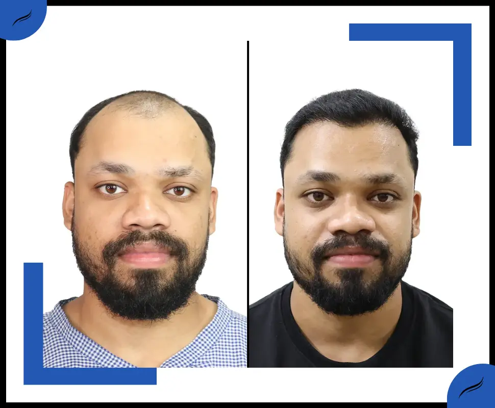Hair Transplant Before and After