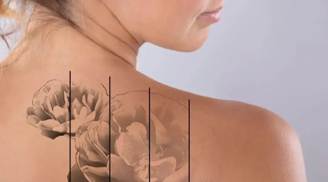Tattoo Removal India | Laser Tattoo Removal Agra