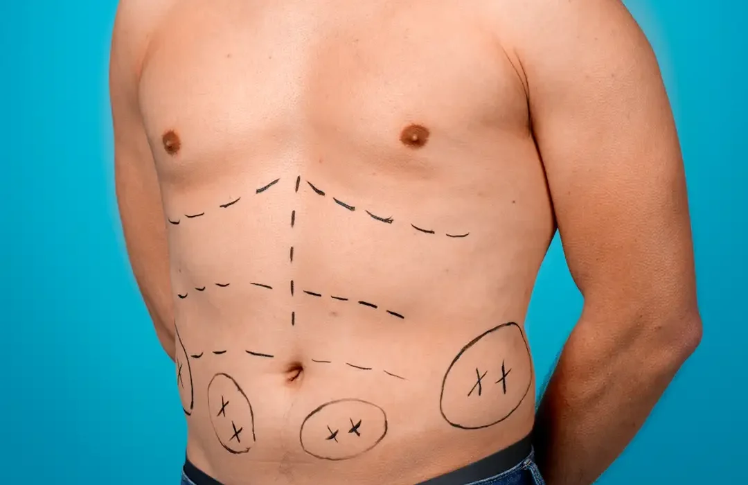 Male Torso ReSculpting India | Gynecomastia Agra | Abdominal Etching