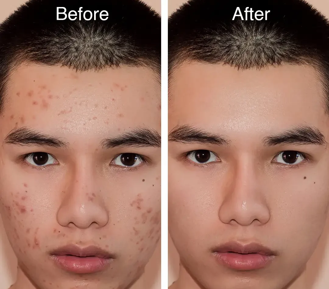 Active Acne Treatment in India