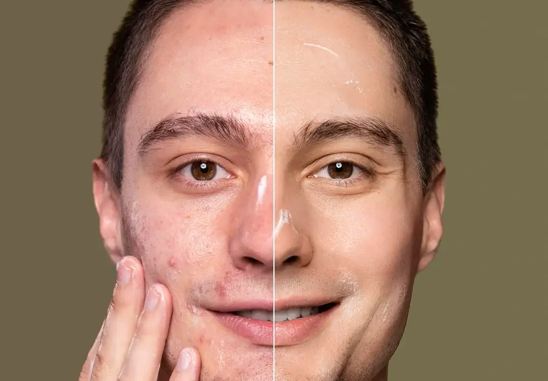 Truncal Acne Scars: A Guide to Diagnosos and Management