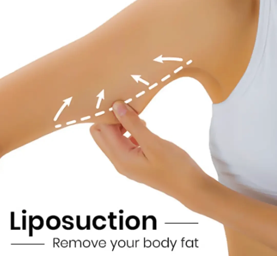 Liposuction Surgery