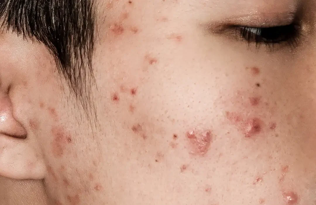 Active Acne Treatment India | Skin Treatment Agra | Cosmetology