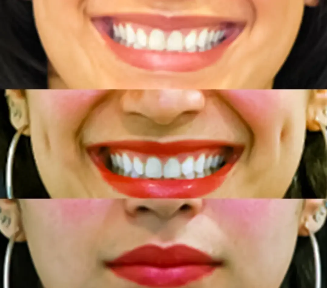 Dimple Creation Surgery