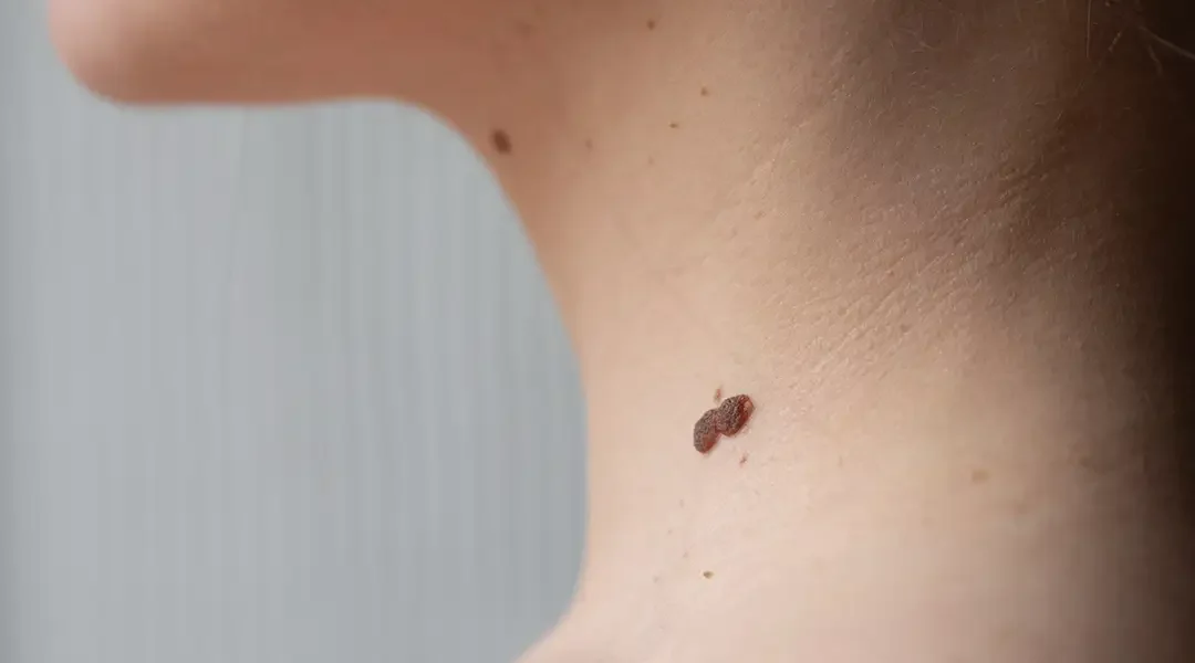 Skin Tags