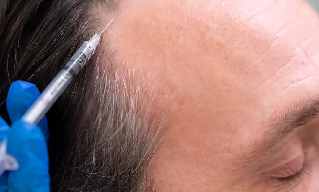 Side Effects of Mesotherapy