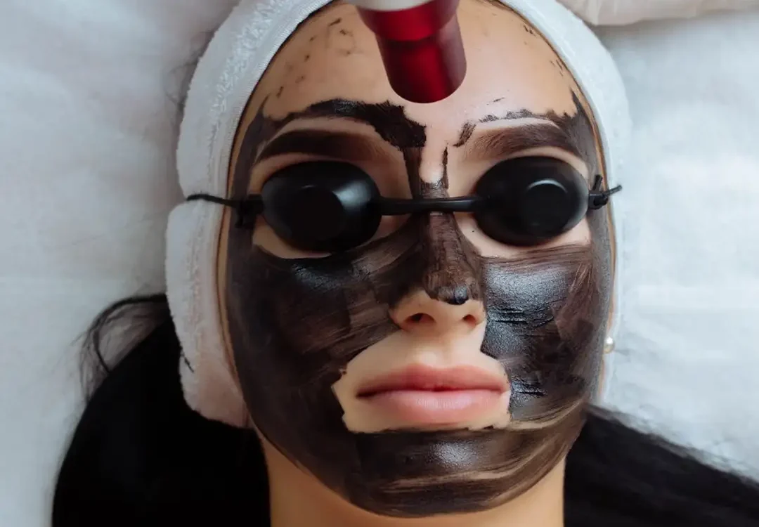 Carbon Peel Laser Treatment