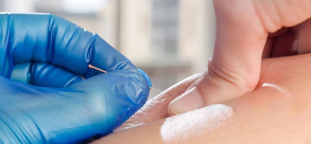 Dry Needling Therapy