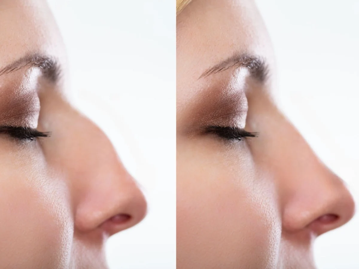 Side By Side Comparison of Rhinoplasty