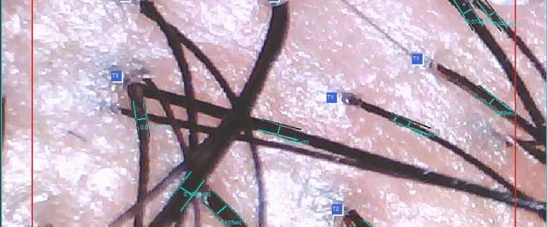 Follicle units on the scalp