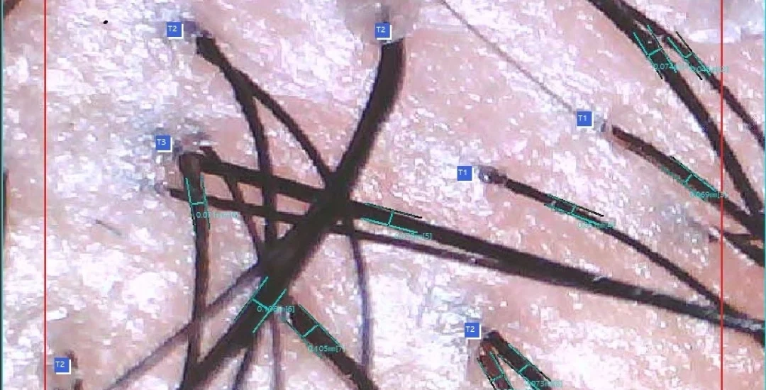 Follicle units on the scalp