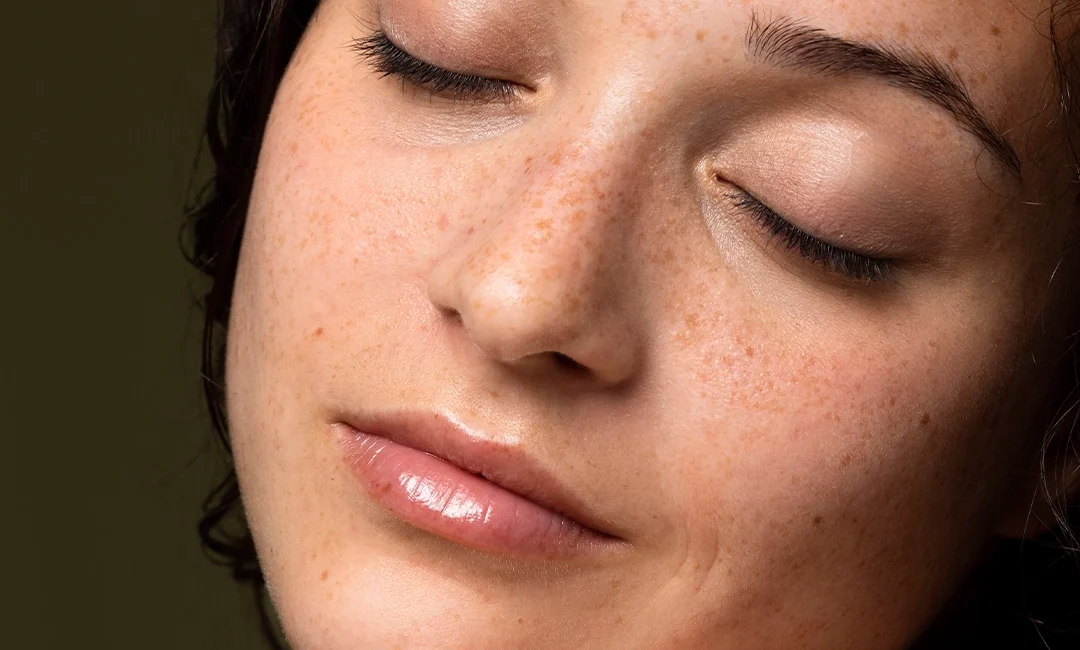 Freckles Treatment: What it is, Types, Causes & Treatments