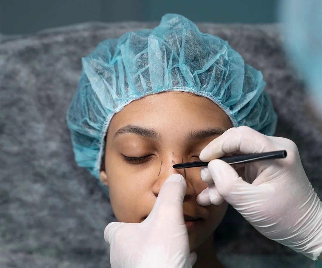 Best Rhinoplasty (Nose Job) in Agra, India | Cost, Before and After