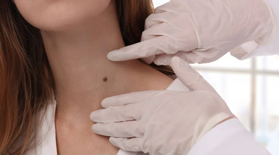 Warts Removal India | Mole Removal Agra | Laser Treatments