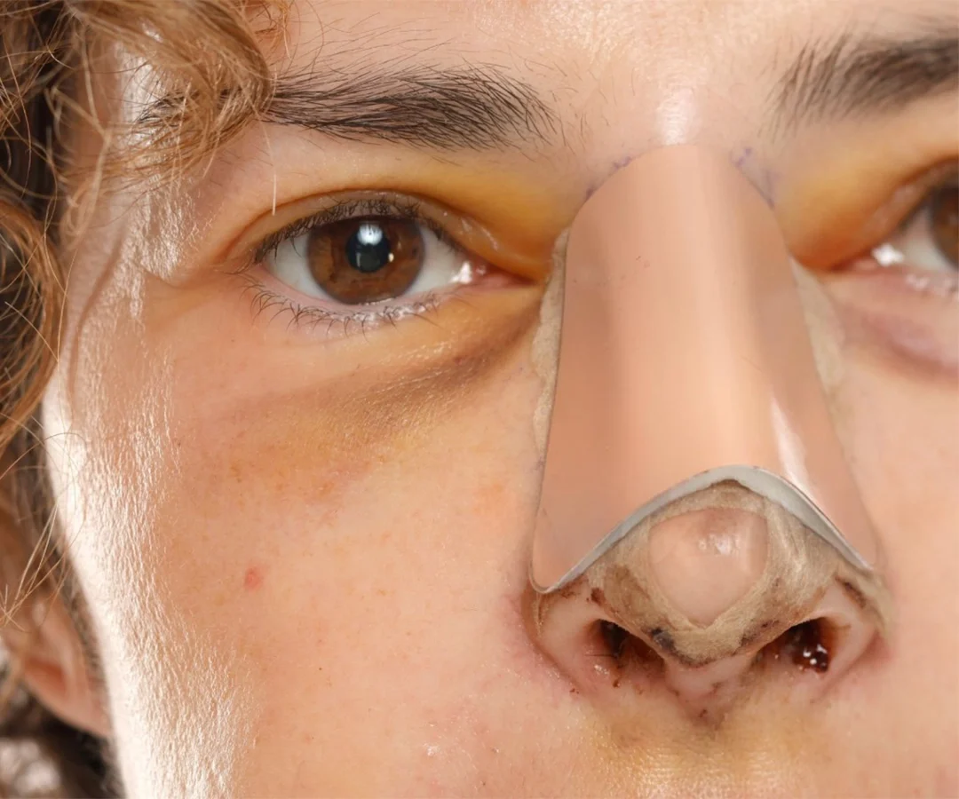 Closer Look of Cleft Rhinoplasty Surgery