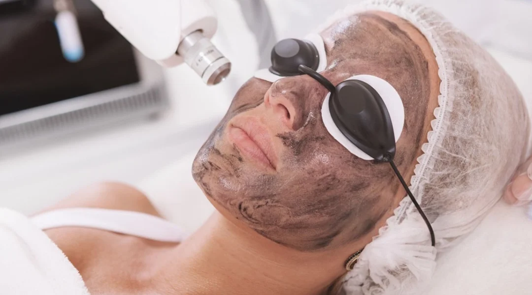 Carbon Peel Laser Facial in India | Treatment for Acne & Pores