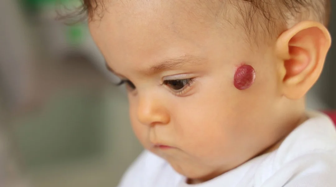 Haemangioma treatment