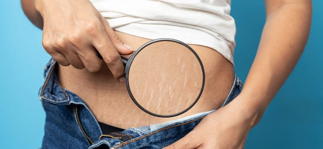 Stretch Marks: Symptoms, Treatment Options & Prevention Tips
