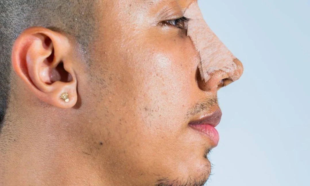 Cleft Rhinoplasty Surgery in India - Results | Saraswat Hospital