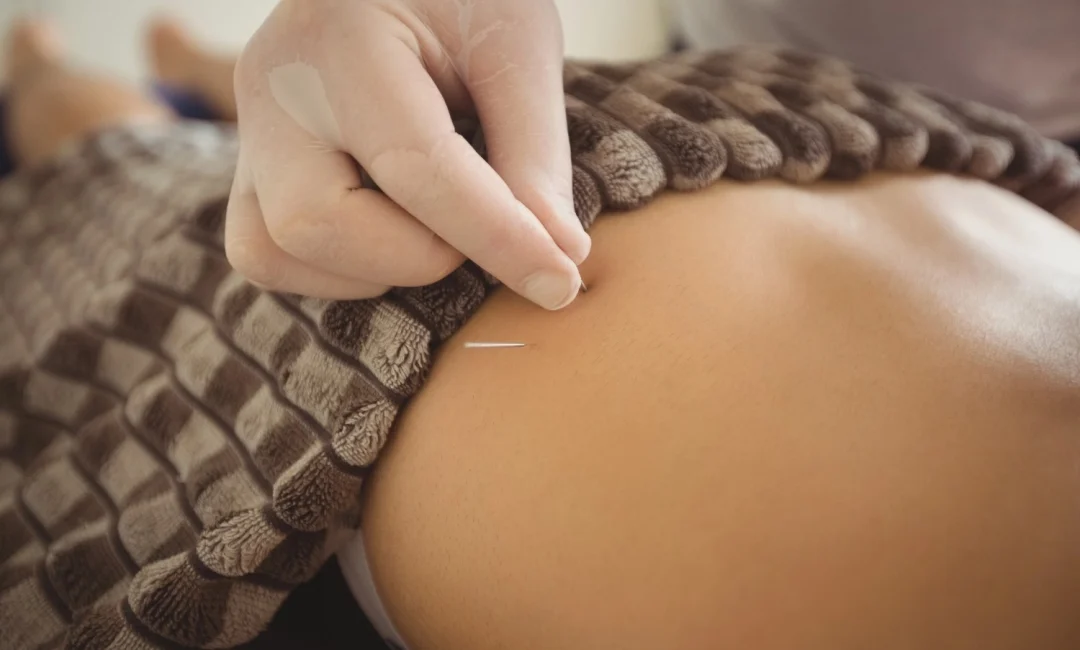 Dry Needling Therapy? | Conditions & Benefits | Saraswat Hospital