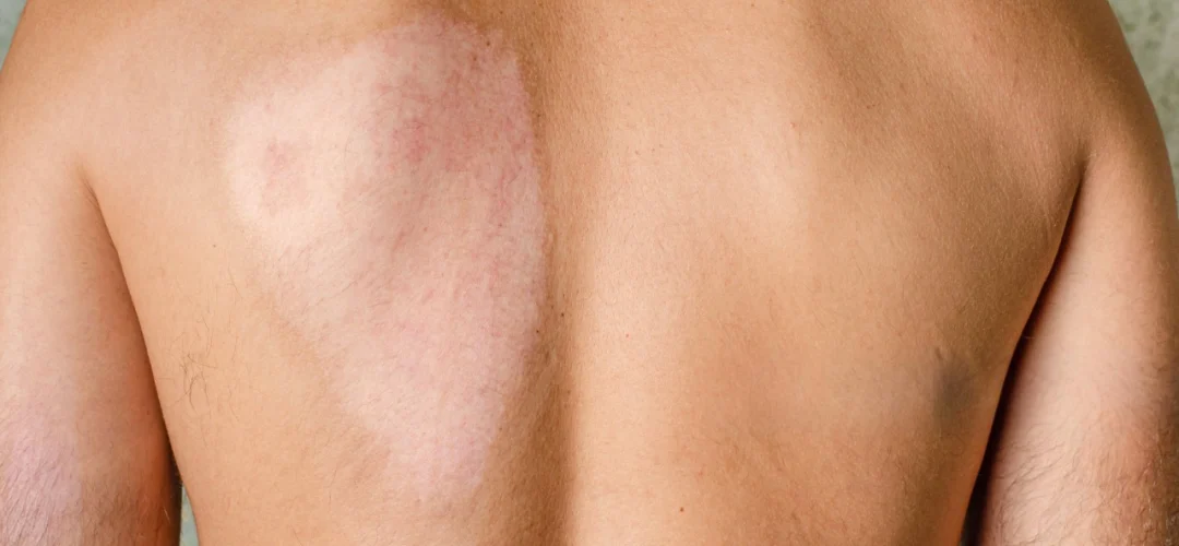 Best Skin Graft Surgery in India | Types, Benefits & Recovery