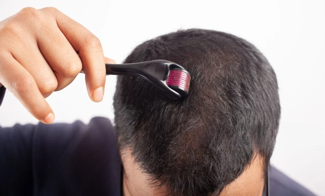 Derma Roller for Hair Loss Treatment