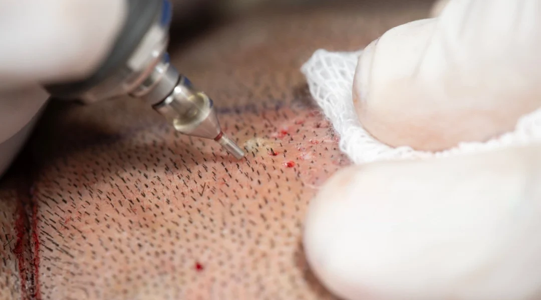 FUE Hair Transplant in India