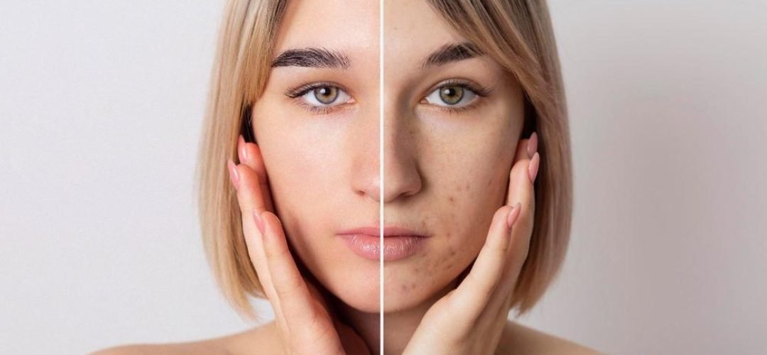 Acne Scar Treatment in India - Saraswat Hospital Agra